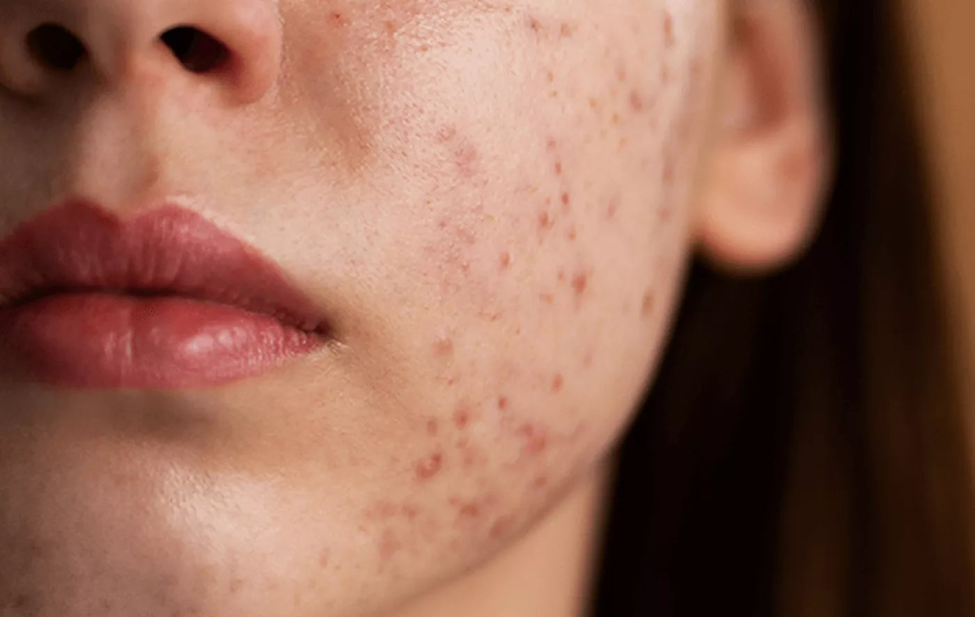 Pimple and Acne: Ayurvedic Treatment and Medicines