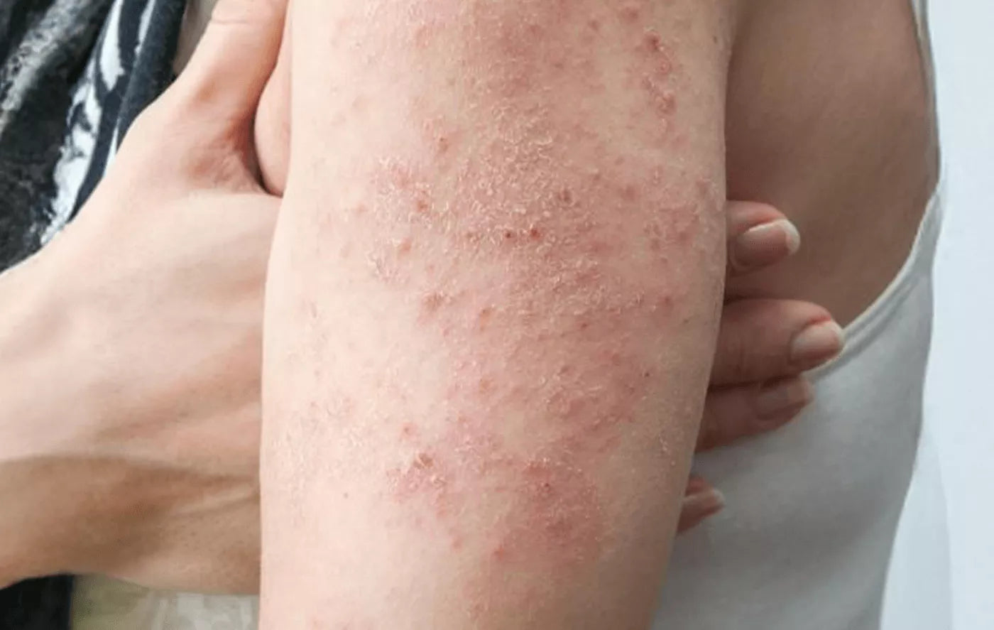 शीतपित्त: आयुर्वेदिक इलाज और घरेलू उपचार